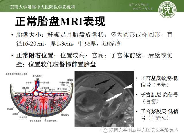 【病例】前置胎盘+胎盘植入1例MR