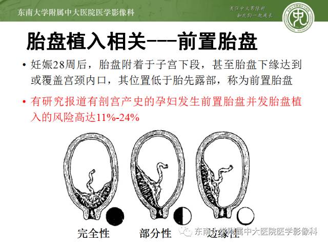 【病例】前置胎盘+胎盘植入1例MR
