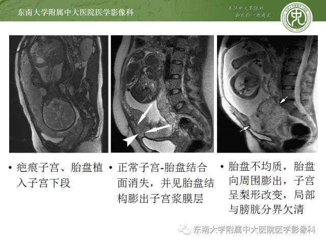 【病例】前置胎盘+胎盘植入1例MR