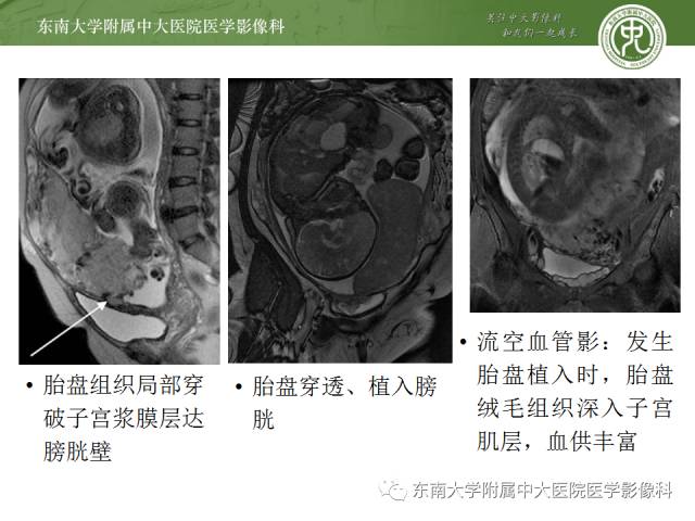 【病例】前置胎盘+胎盘植入1例MR