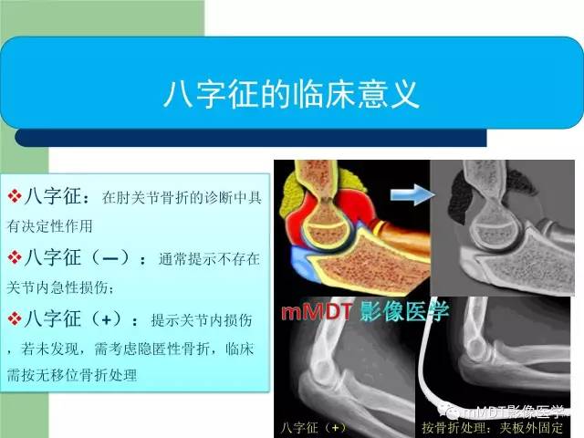 【PPT】儿童肘关节骨折的X线诊断
