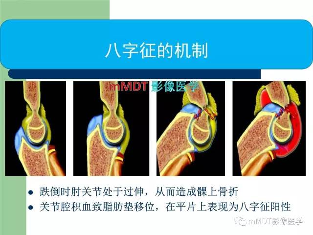 【PPT】儿童肘关节骨折的X线诊断