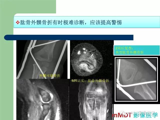 【PPT】儿童肘关节骨折的X线诊断
