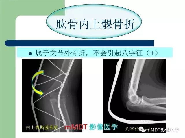 【PPT】儿童肘关节骨折的X线诊断