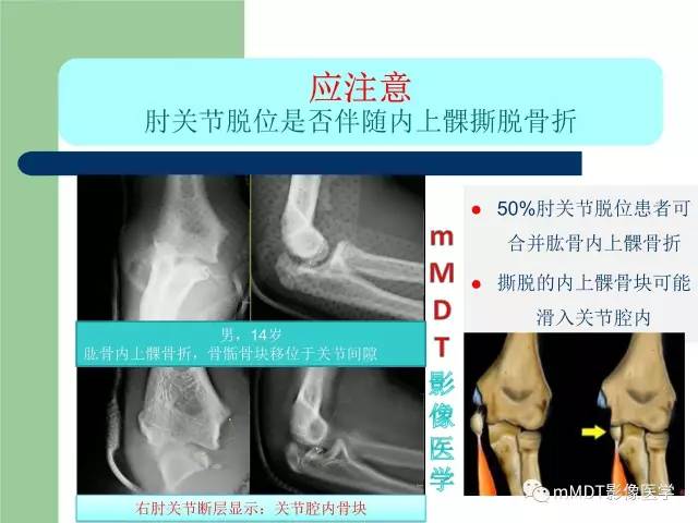 【PPT】儿童肘关节骨折的X线诊断
