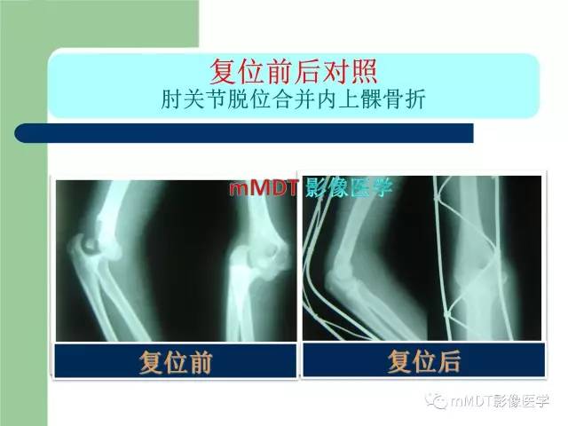 【PPT】儿童肘关节骨折的X线诊断