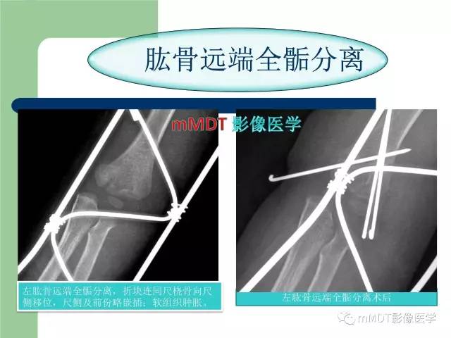 【PPT】儿童肘关节骨折的X线诊断