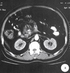 【病例】小肠B细胞淋巴肉瘤1例CT 【病例】小肠B细胞淋巴肉瘤1例CT