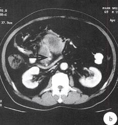 【病例】小肠B细胞淋巴肉瘤1例CT