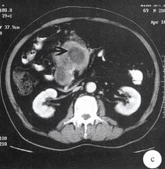 【病例】小肠B细胞淋巴肉瘤1例CT 【病例】小肠B细胞淋巴肉瘤1例CT