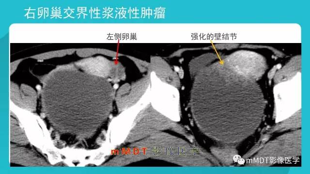 【PPT】卵巢肿瘤影像诊断
