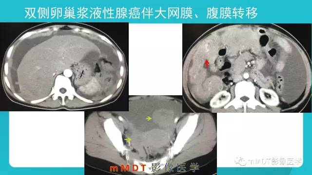 【PPT】卵巢肿瘤影像诊断