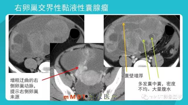 【PPT】卵巢肿瘤影像诊断