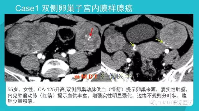 【PPT】卵巢肿瘤影像诊断