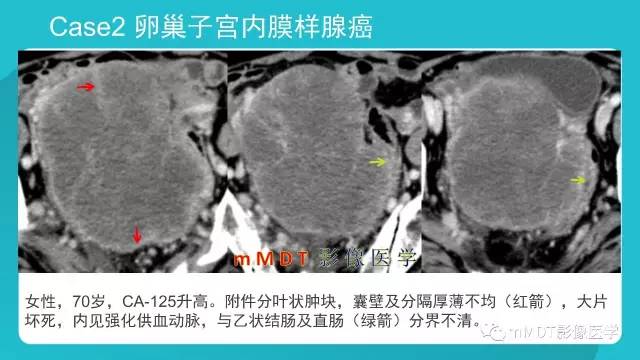 【PPT】卵巢肿瘤影像诊断