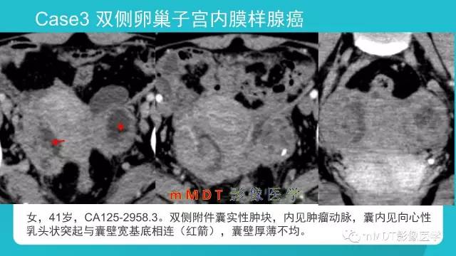 【PPT】卵巢肿瘤影像诊断