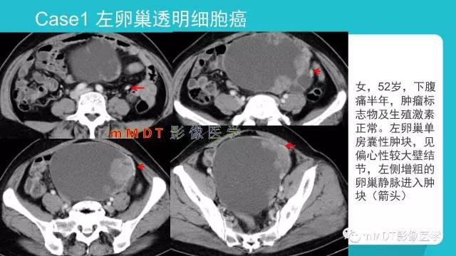 【PPT】卵巢肿瘤影像诊断