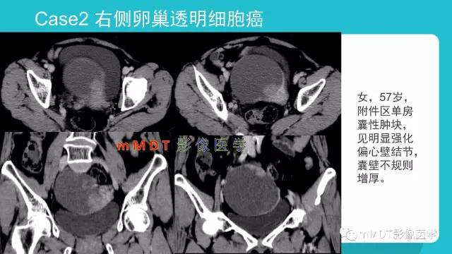 【PPT】卵巢肿瘤影像诊断