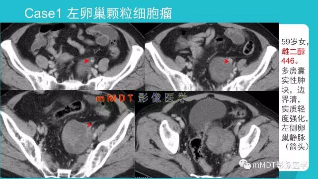【PPT】卵巢肿瘤影像诊断