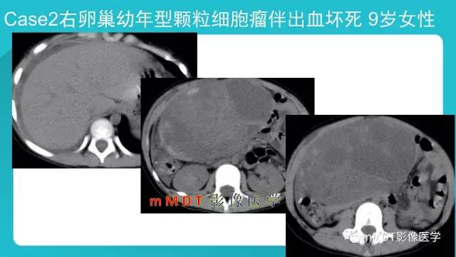 【PPT】卵巢肿瘤影像诊断