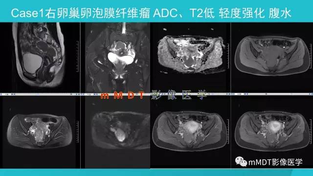 【PPT】卵巢肿瘤影像诊断
