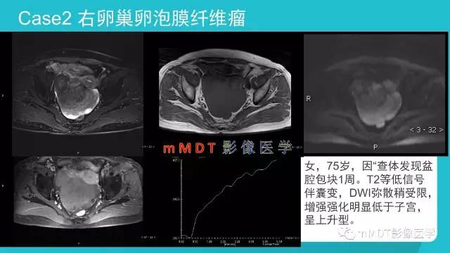 【PPT】卵巢肿瘤影像诊断