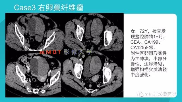 【PPT】卵巢肿瘤影像诊断