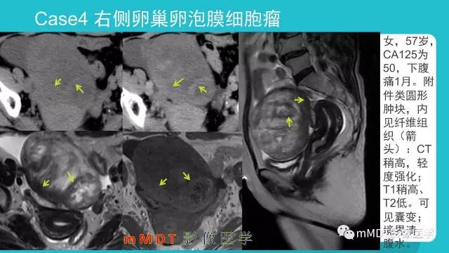 【PPT】卵巢肿瘤影像诊断
