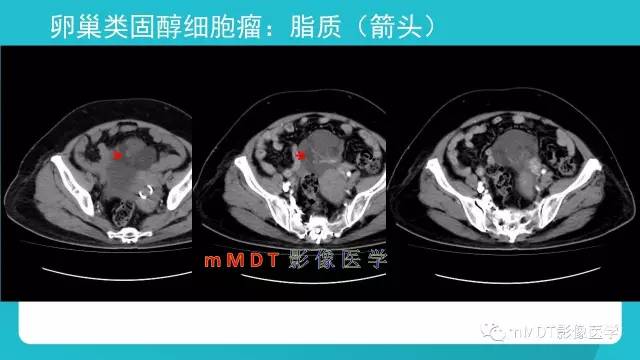 【PPT】卵巢肿瘤影像诊断