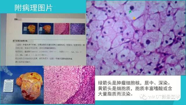 【PPT】卵巢肿瘤影像诊断