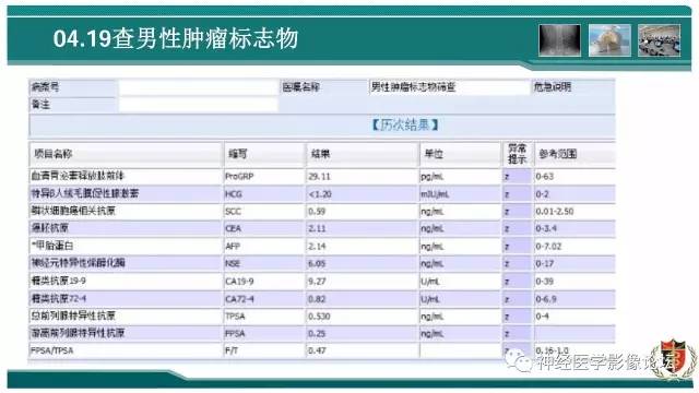 【病例】难得一见的IgG4脑炎MR
