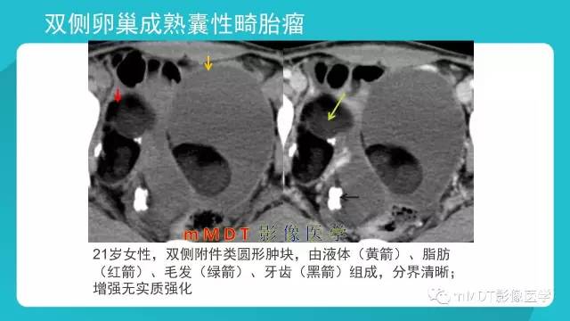 【PPT】卵巢肿瘤影像诊断