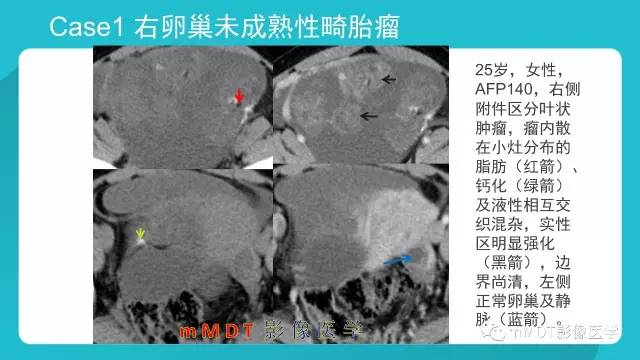 【PPT】卵巢肿瘤影像诊断