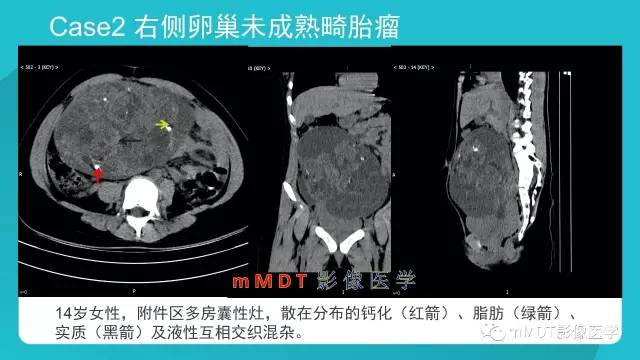 【PPT】卵巢肿瘤影像诊断
