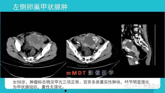 【PPT】卵巢肿瘤影像诊断