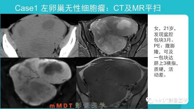 【PPT】卵巢肿瘤影像诊断