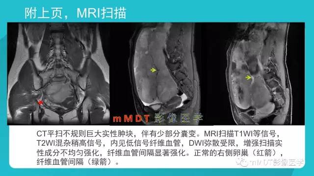 【PPT】卵巢肿瘤影像诊断
