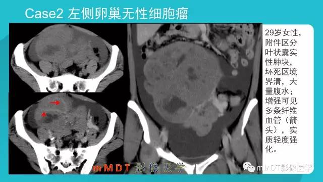 【PPT】卵巢肿瘤影像诊断