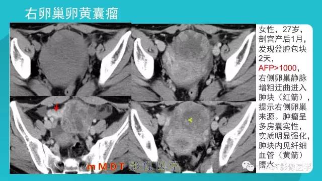【PPT】卵巢肿瘤影像诊断