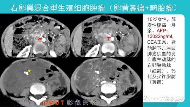 【PPT】卵巢肿瘤影像诊断