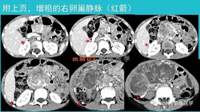 【PPT】卵巢肿瘤影像诊断