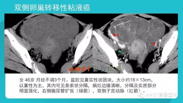 【PPT】卵巢肿瘤影像诊断