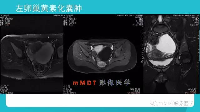 【PPT】卵巢肿瘤影像诊断