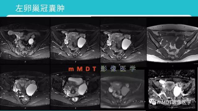 【PPT】卵巢肿瘤影像诊断