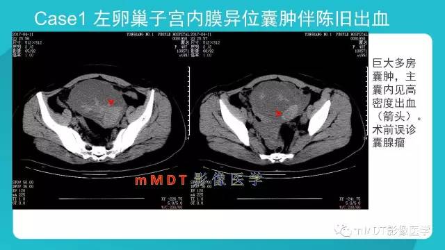 【PPT】卵巢肿瘤影像诊断