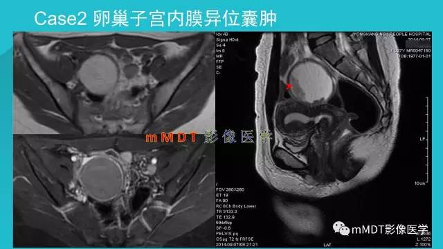 【PPT】卵巢肿瘤影像诊断