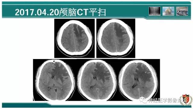 【病例】难得一见的IgG4脑炎MR