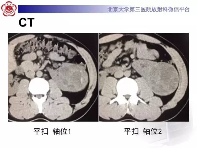 【病例】左肾上皮样血管平滑肌脂肪瘤1例CT及MR