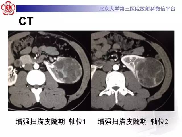 【病例】左肾上皮样血管平滑肌脂肪瘤1例CT及MR
