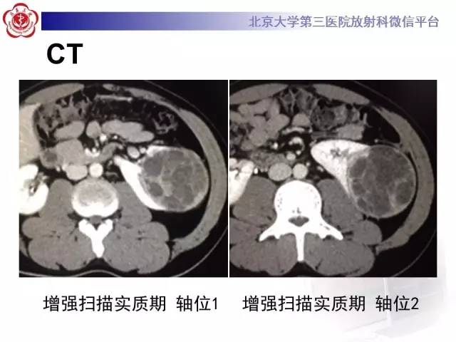 【病例】左肾上皮样血管平滑肌脂肪瘤1例CT及MR